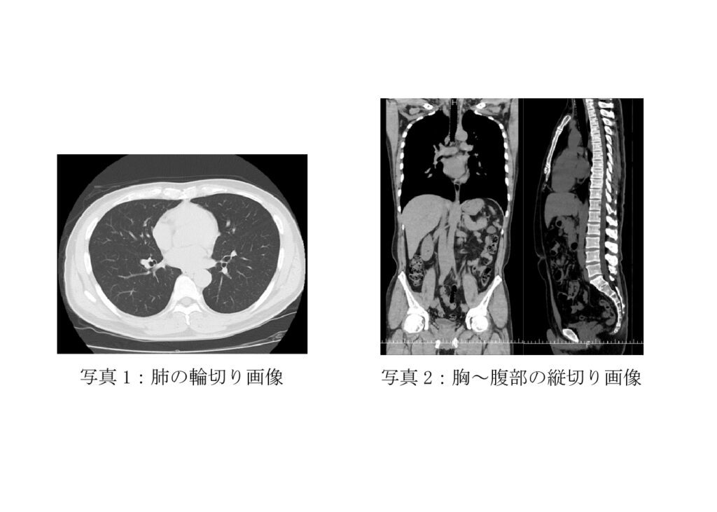 最近のCT装置はすごいんです！（CT画像）