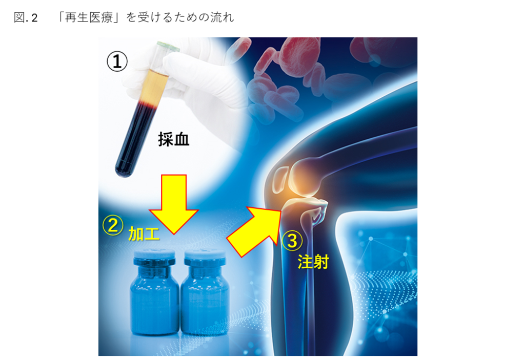 関節の再生医療とは？